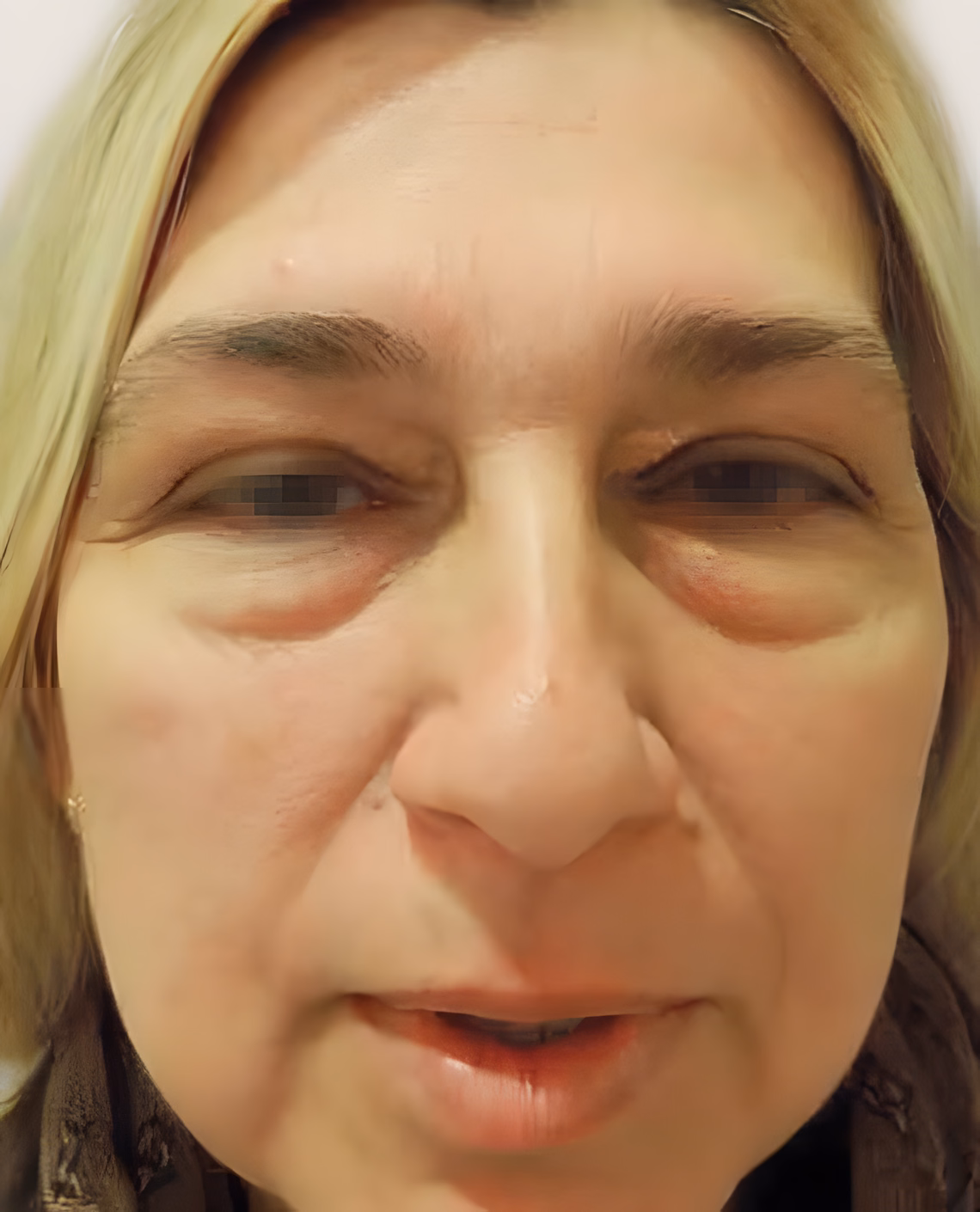 Antes — Antes y después de una Blefaroplastia