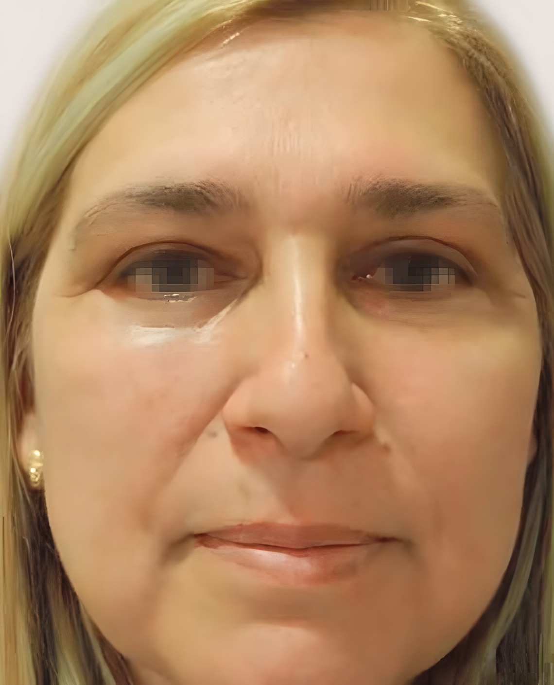 Después — Antes y después de una Blefaroplastia