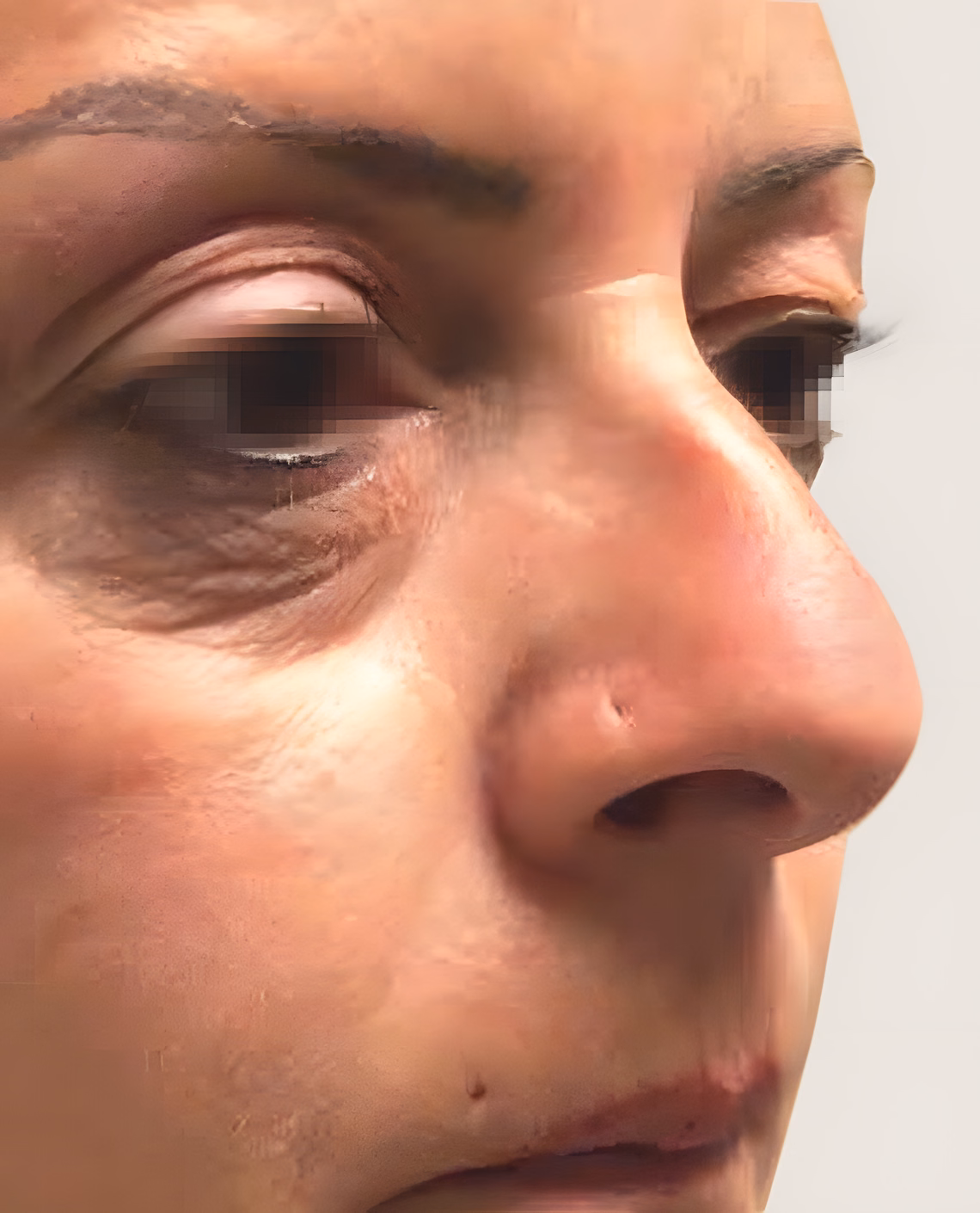 Antes — Antes y después de una Blefaroplastia