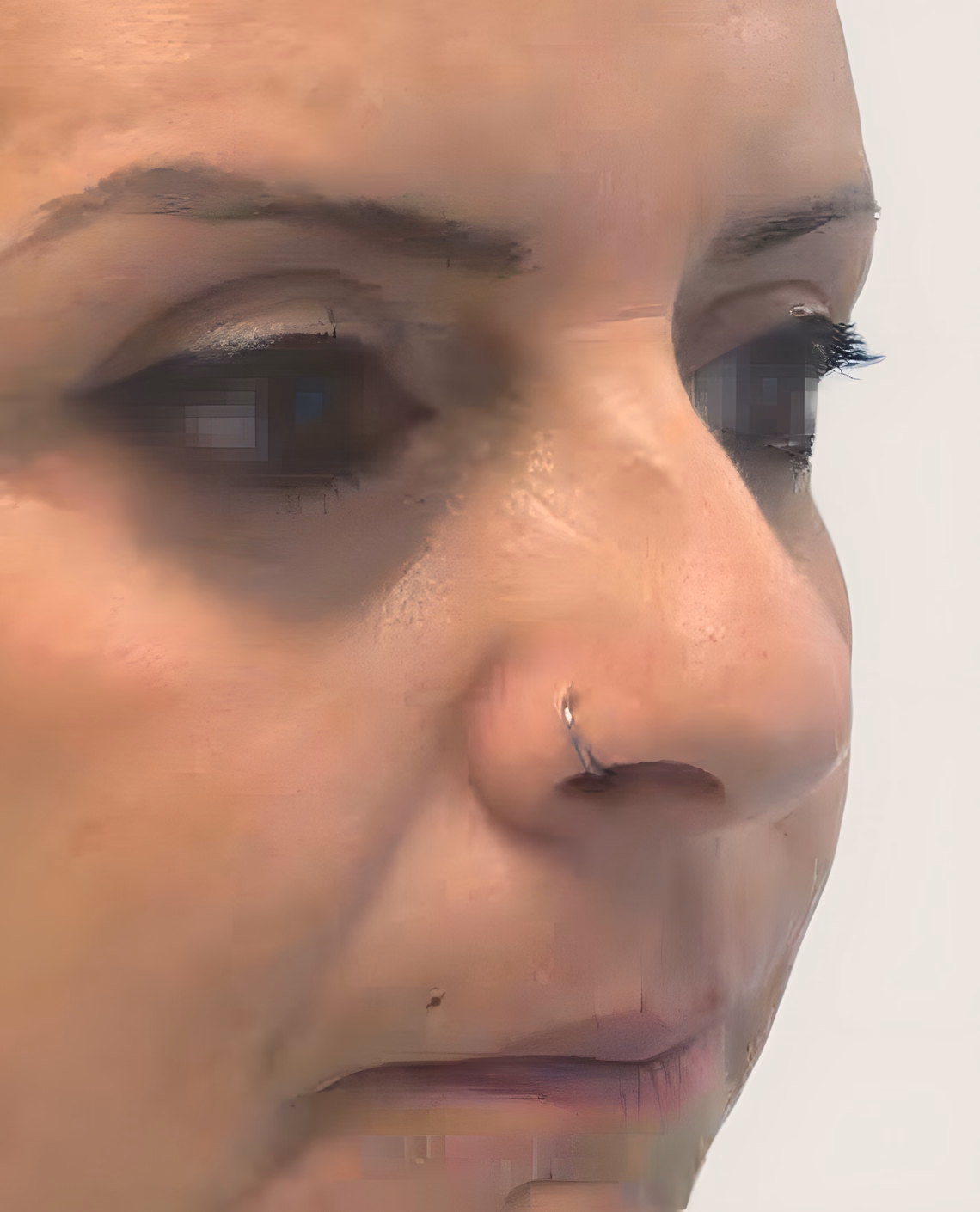 Después — Antes y después de una Blefaroplastia