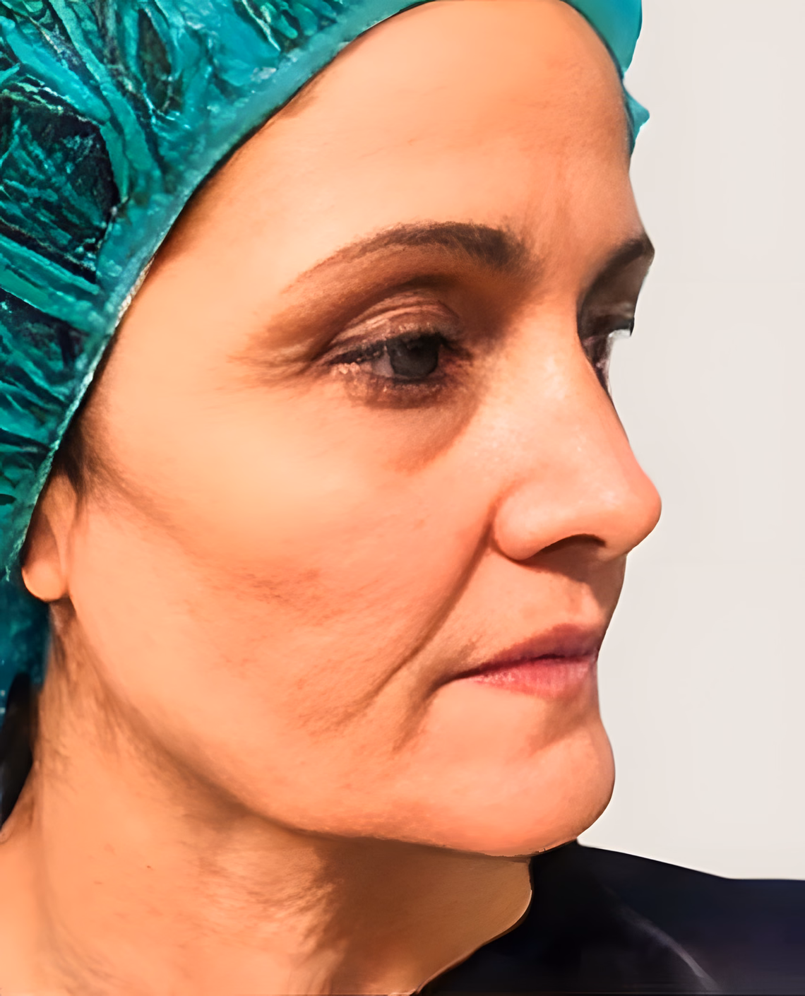 Antes — Antes y después del lifting facial