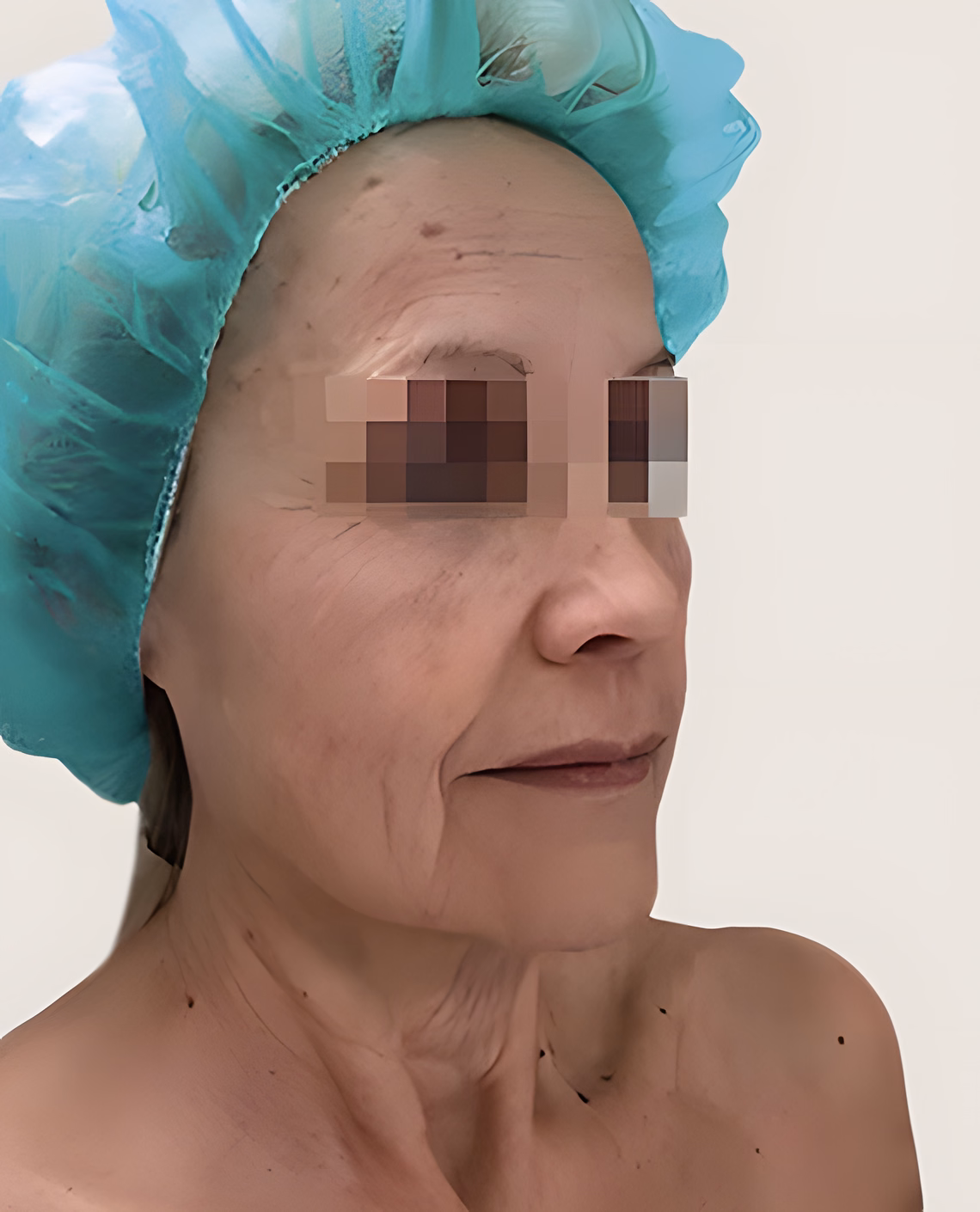Antes — Antes y después del lifting facial