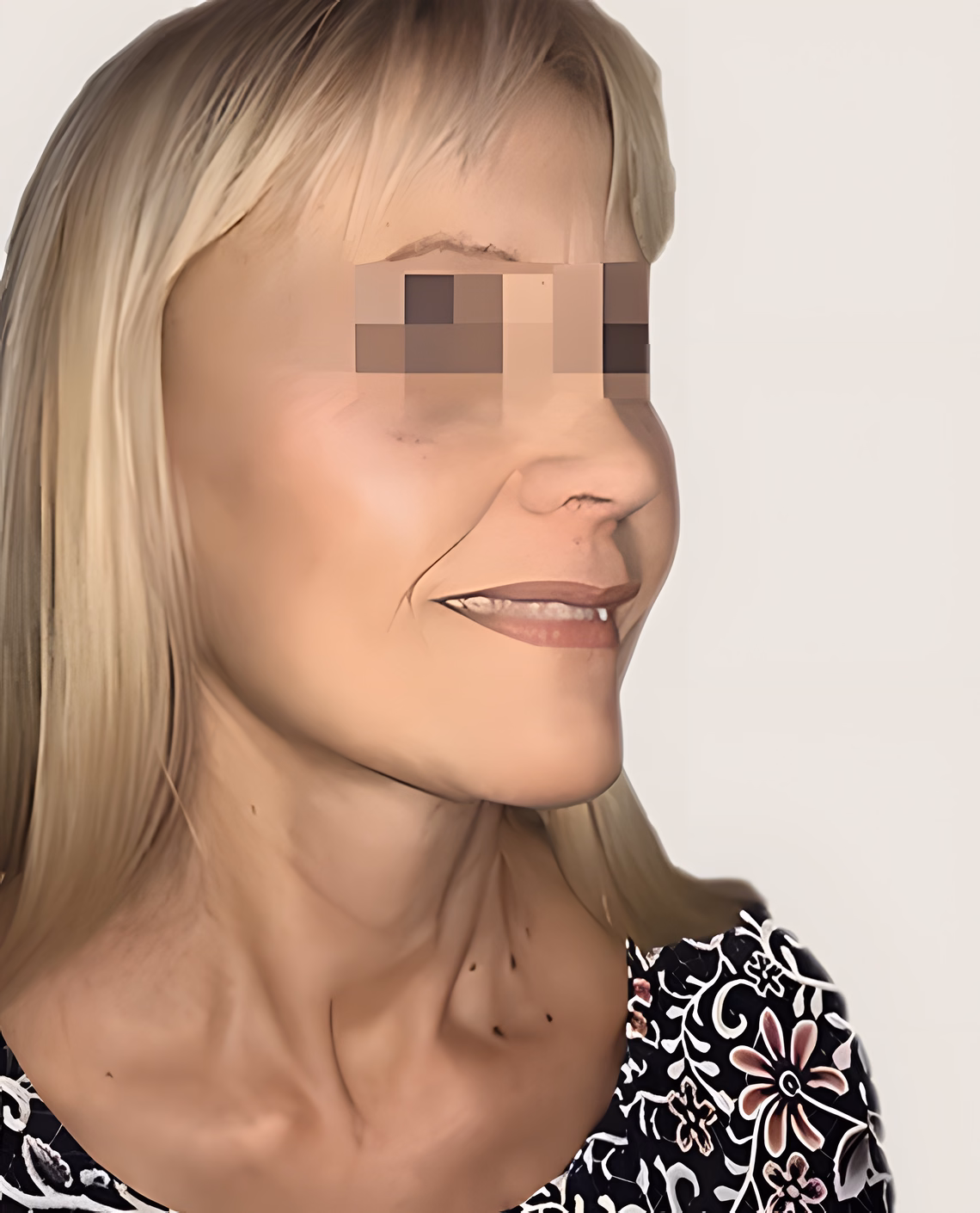 Después — Antes y después del lifting facial