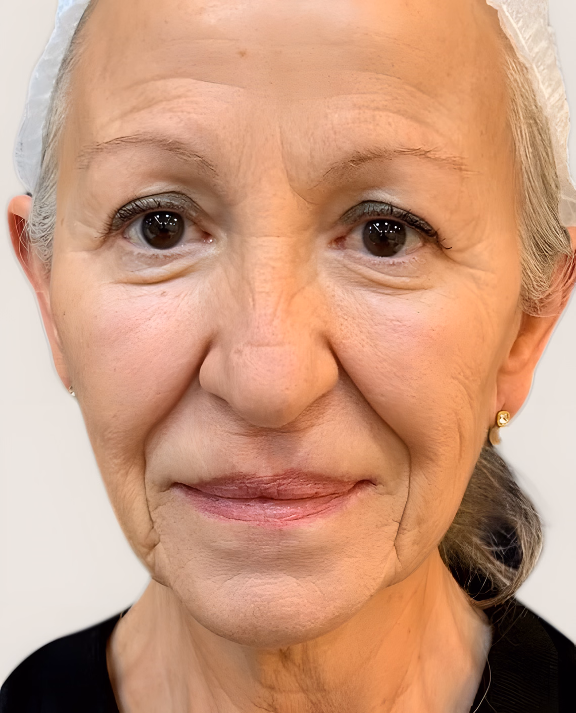 Antes — Rejuvenecimiento facial