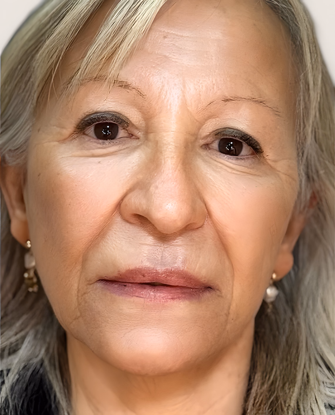 Después — Rejuvenecimiento facial