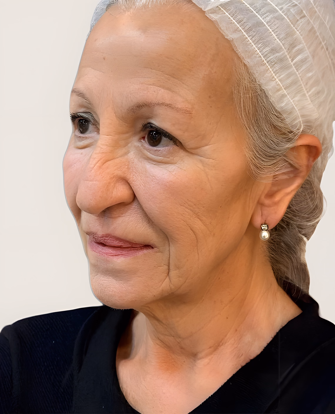 Antes — Rejuvenecimiento facial
