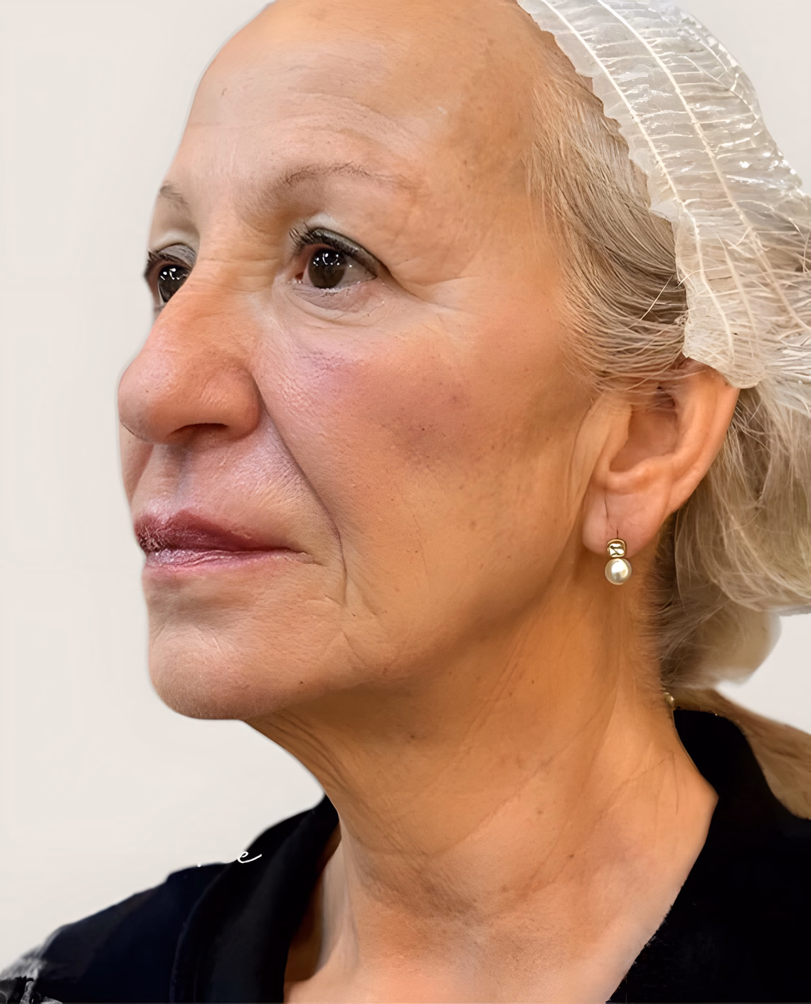Después — Rejuvenecimiento facial
