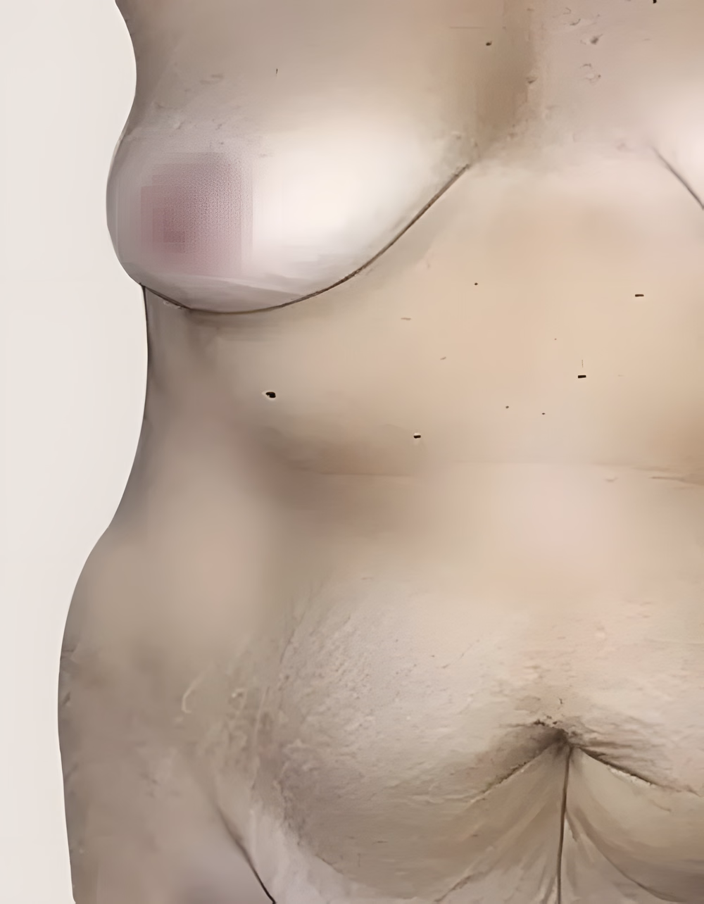 Antes — Abdominoplastia
