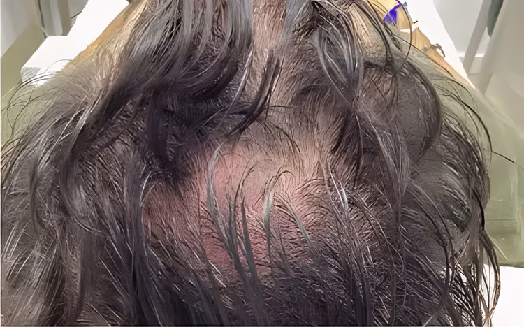 Antes — Mesoterapia Capilar