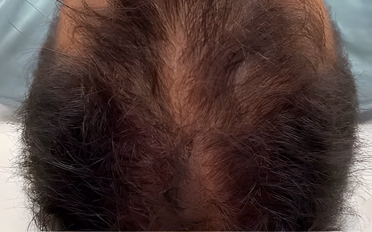 Antes — Mesoterapia Capilar