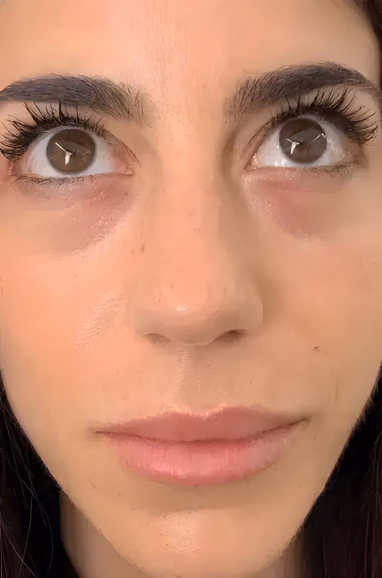 Antes — Micropigmentación Ojeras