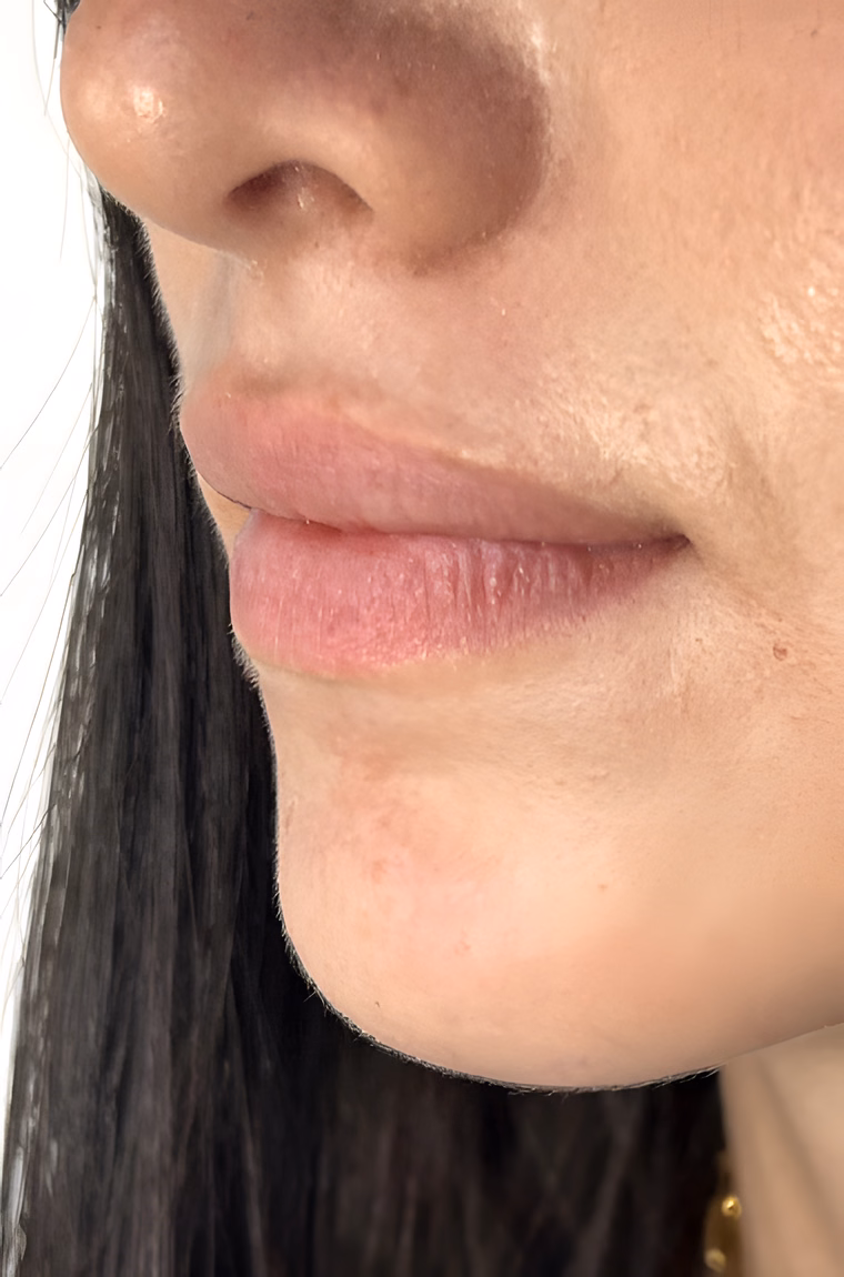 Antes — Micropigmentación de Labios