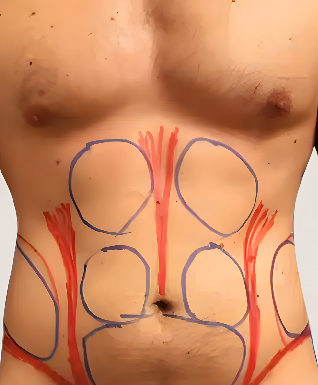 Antes — Lipoescultura