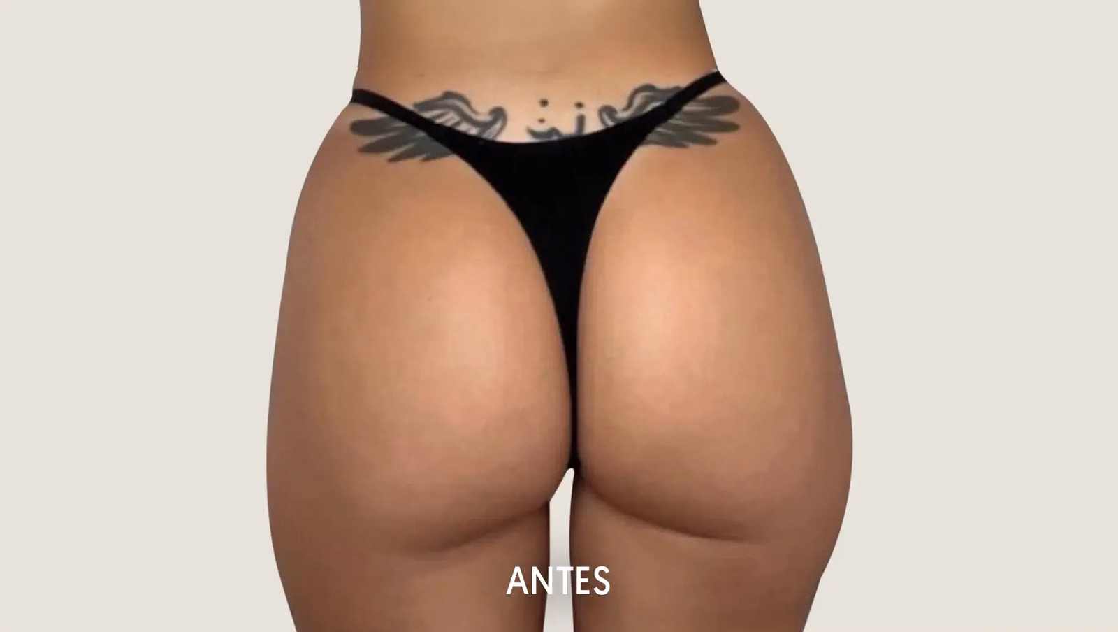 Antes — Aumento de glúteos