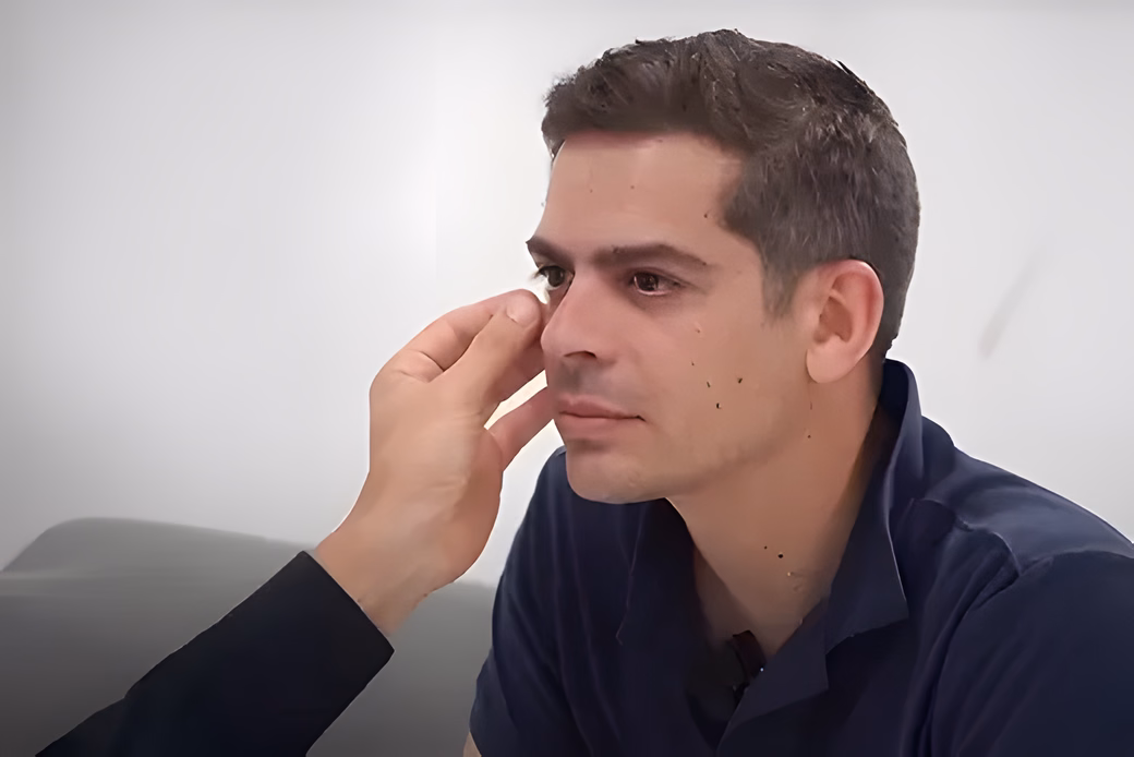 Brian Cross i la seva Blefaroplàstia i lipovaser