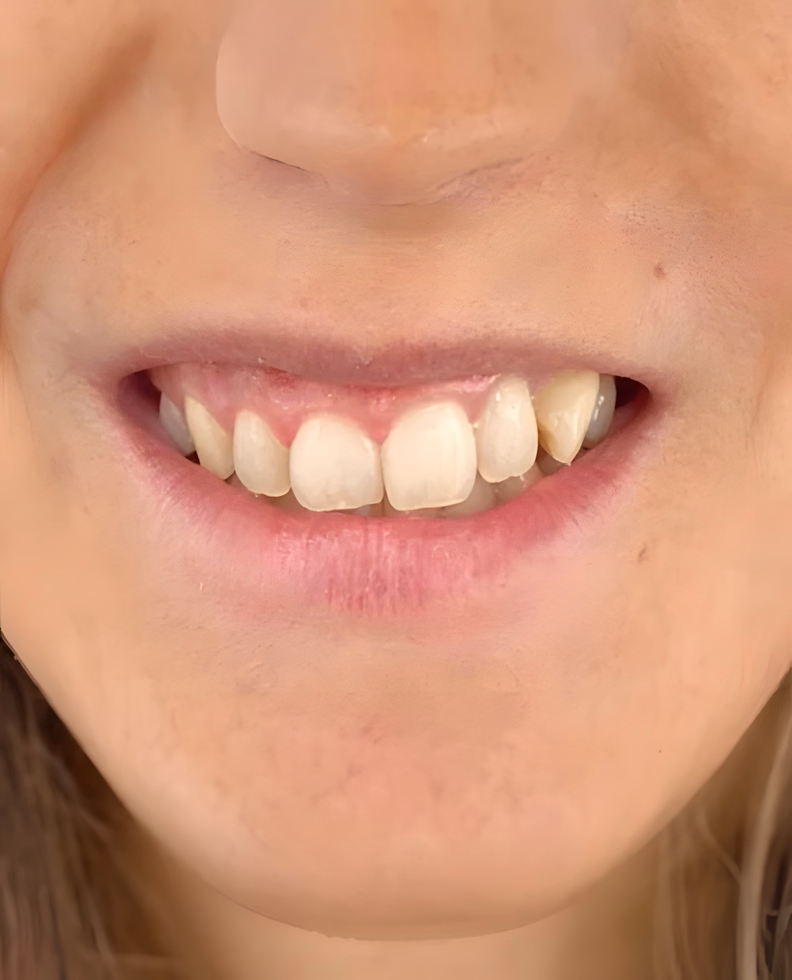 Antes — Sonrisa gingival