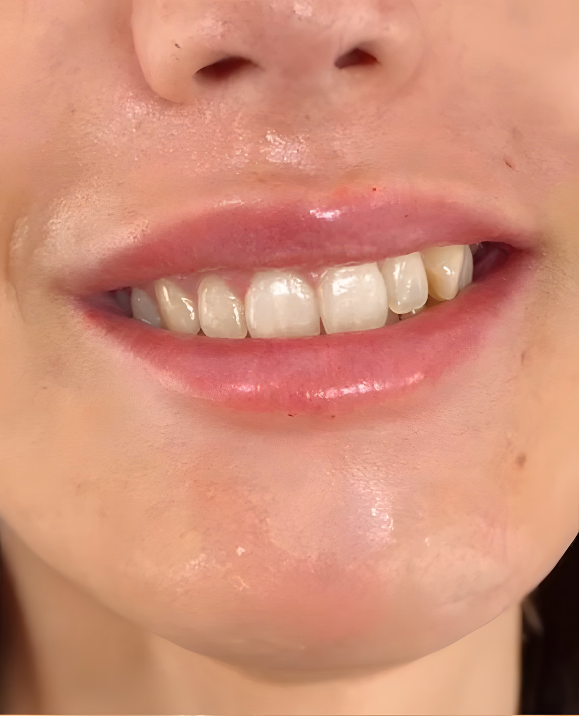 Después — Sonrisa gingival