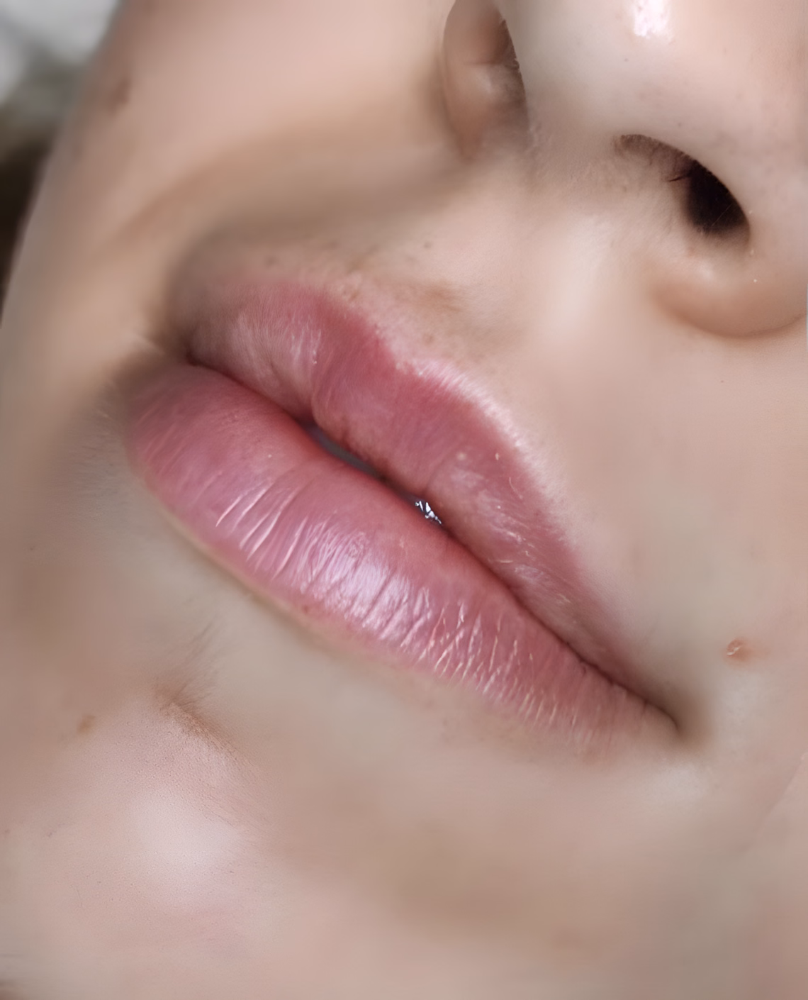 Antes — Relleno de labios