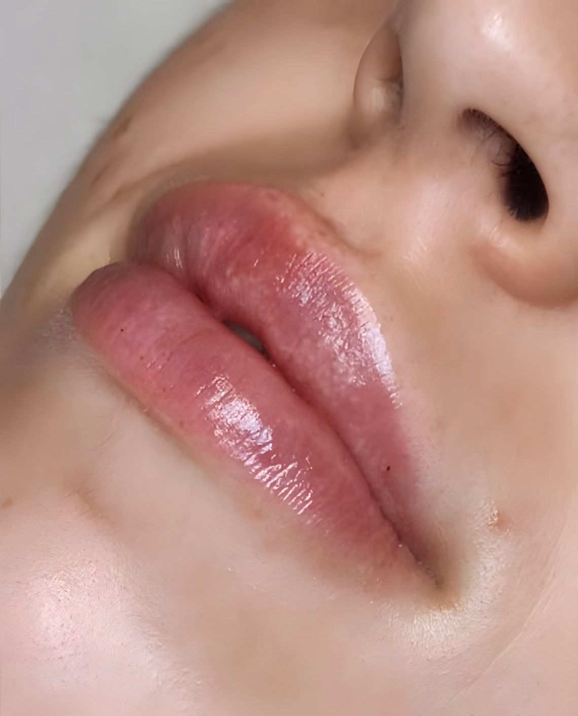 Después — Relleno de labios