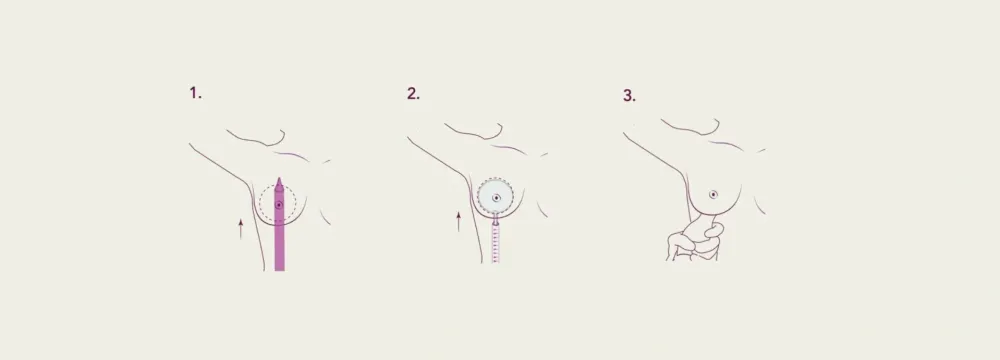  Preservé: la técnica minimalista que cuida tu sensibilidad mamaria