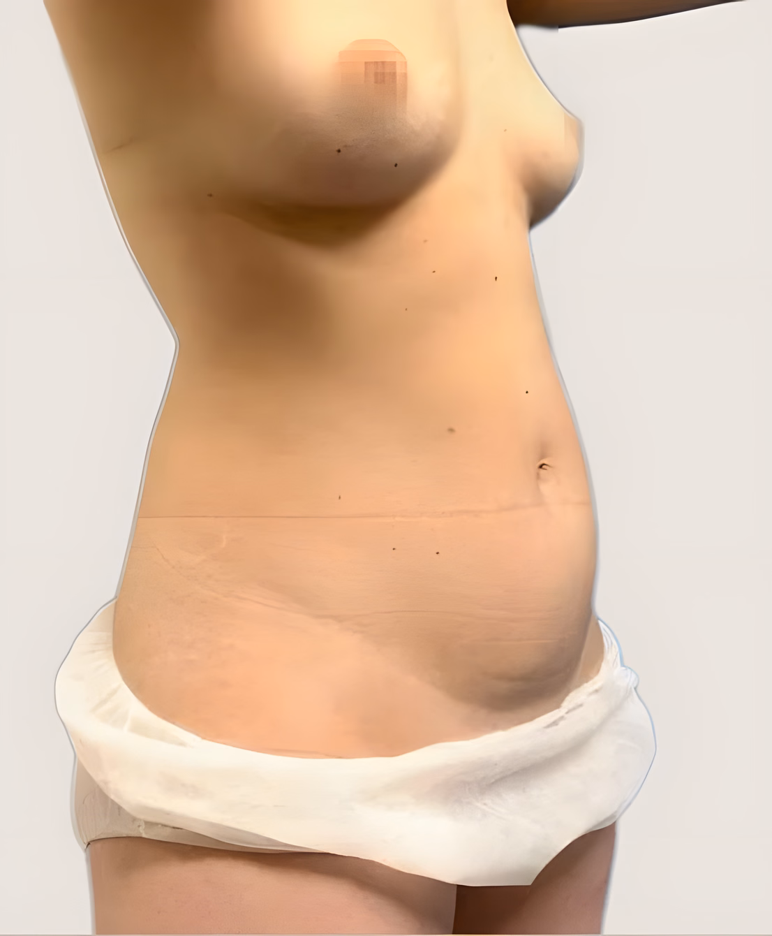 Antes — Liposucción VASER