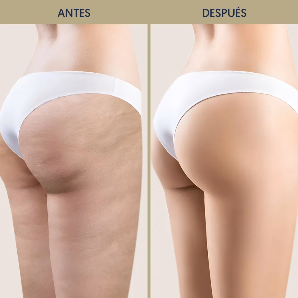 Fotos de antes e depois da pressoterapia